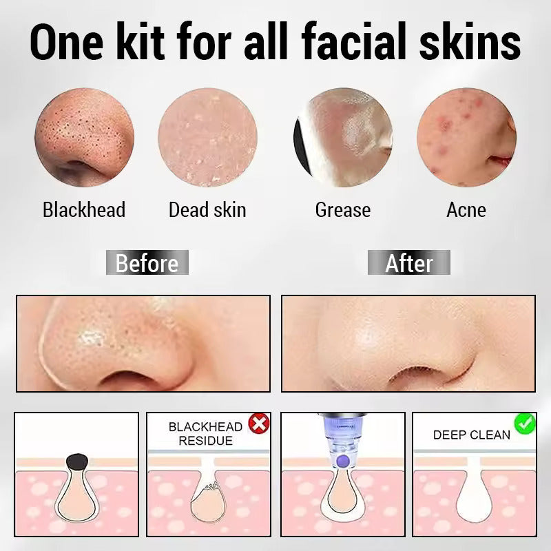 Electric Blackhead Acne Oil Remover